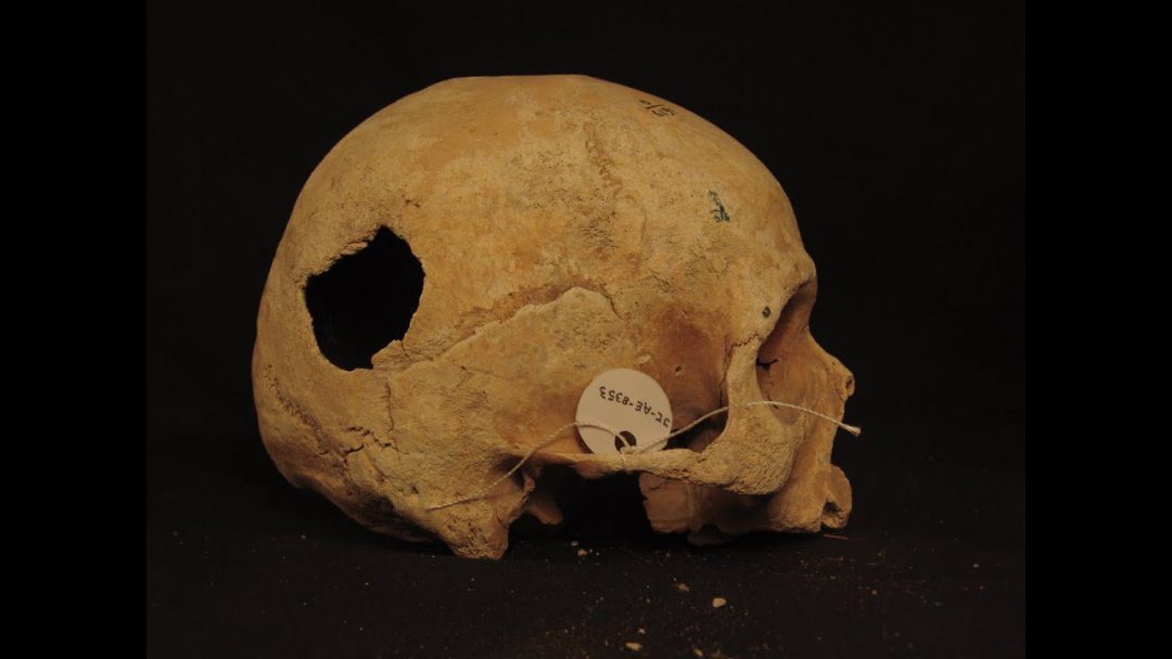 trepanación craneana craneo paracas